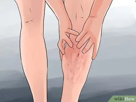 Image intitulée Prevent Varicose Veins Step 13