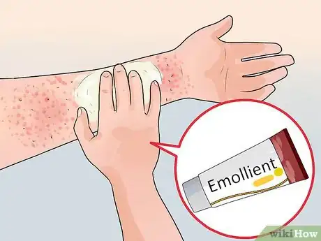 Image intitulée Treat Contact Dermatitis Step 2