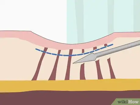 Image intitulée Get Rid of Back Acne Scars Step 14