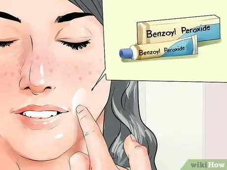 Image intitulée Get Rid of Acne in One Week Step 5