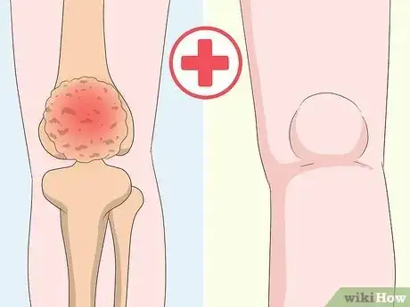 Image intitulée Get Rid of Leg Pain Step 15