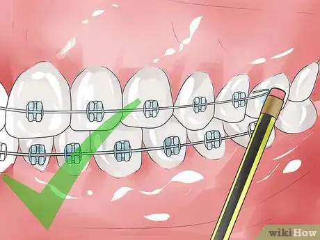 Image intitulée Handle Poking Wires on Braces Step 6