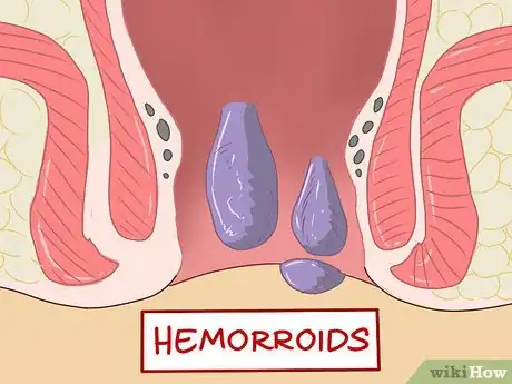 Image intitulée Care for Hemorrhoids Postpartum Step 1