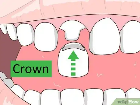 Image intitulée Treat Cavities Step 5