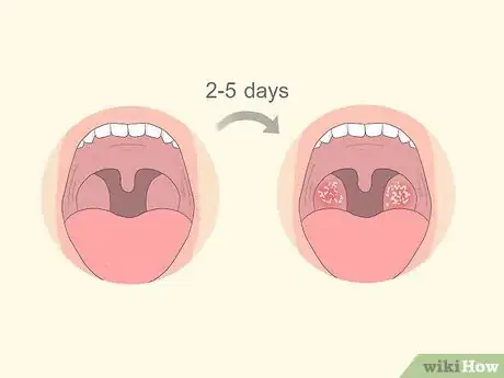 Image intitulée Tell if You Have Strep Throat Step 9