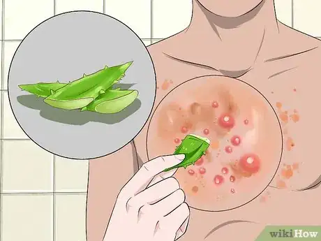 Image intitulée Get Rid of Poison Oak Rash Step 10