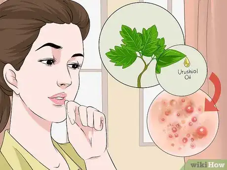 Image intitulée Get Rid of Poison Oak Rash Step 14