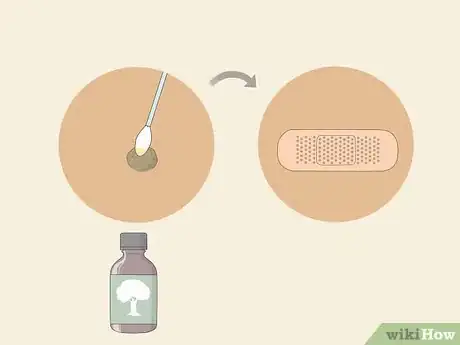 Image intitulée Get Rid of Warts Step 15