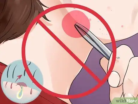 Image intitulée Remove Ingrown Hair on Your Face Step 8