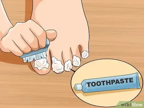 Image intitulée Get Rid of Yellow Toenails Step 14