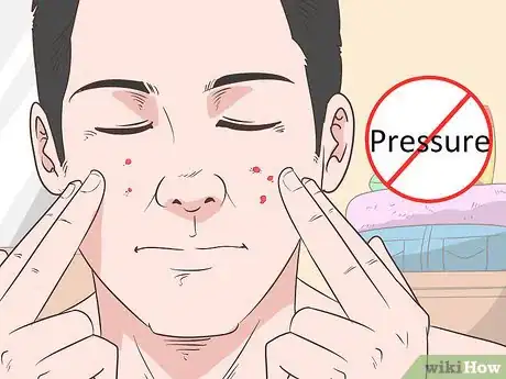 Image intitulée Quickly Heal Open Sores on Your Face Step 15