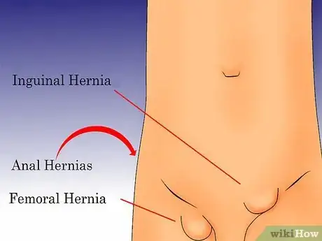 Image intitulée Check for a Hernia Step 2