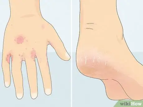 Image intitulée Heal Cracked Skin Step 1