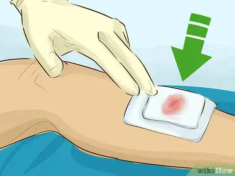 Image intitulée Stop Bleeding Step 19