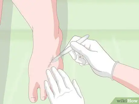 Image intitulée Get Rid of Scars Step 10