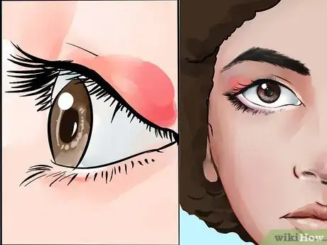 Image intitulée Treat Eye Infection Naturally Step 8