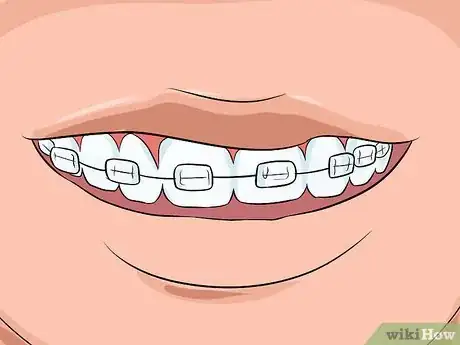 Image intitulée Choose the Color of Your Braces Step 11