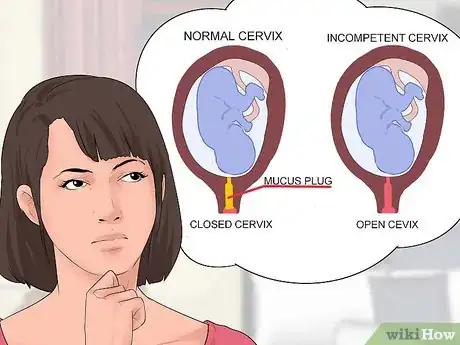 Image intitulée Prevent Incompetent Cervix Step 1