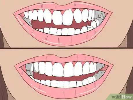 Image intitulée Straighten Your Teeth Without Braces Step 16