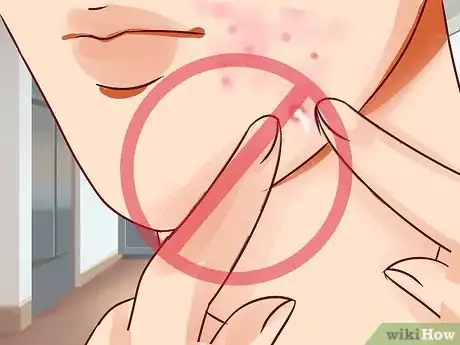 Image intitulée Get Rid of a Deep Pimple Step 15
