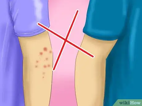 Image intitulée Avoid Catching Scabies Step 1