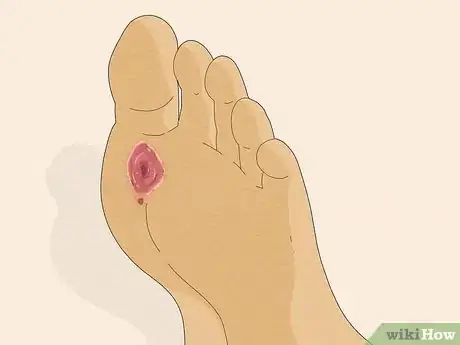 Image intitulée Know if You Have Neuropathy in Your Feet Step 5