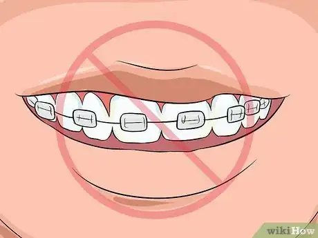 Image intitulée Choose the Color of Your Braces Step 13