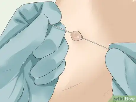 Image intitulée Get Rid of Skin Tags Step 5