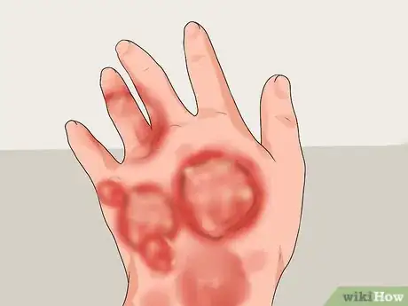 Image intitulée Treat a Hand Burn Step 19