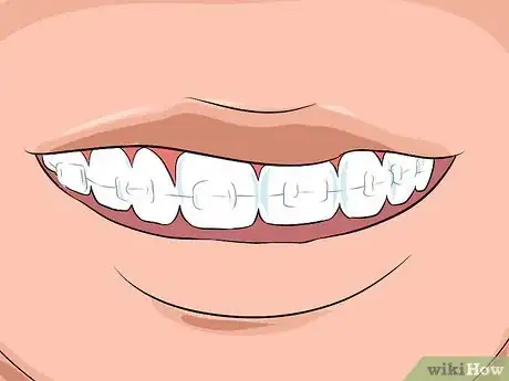 Image intitulée Choose the Color of Your Braces Step 12