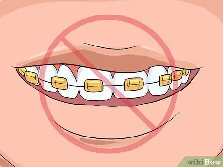 Image intitulée Choose the Color of Your Braces Step 14