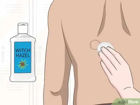 Image intitulée Remove a Cyst on Your Back Step 12