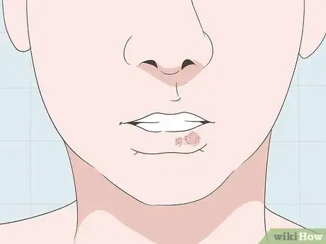 Image intitulée Cover Up a Cold Sore Step 1