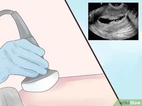 Image intitulée Treat Blocked Fallopian Tubes Step 4