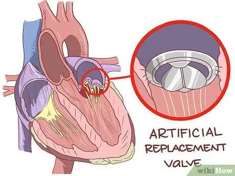 Image intitulée Treat an Enlarged Heart Step 11