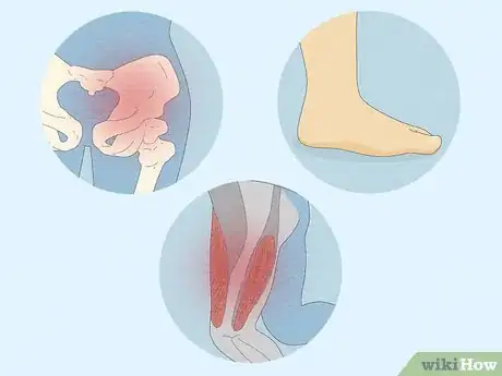 Image intitulée Fix Out Toeing in Adults Step 1