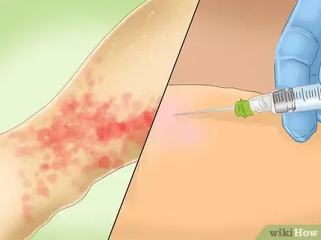 Image intitulée Treat Pinpoint Petechiae Step 5