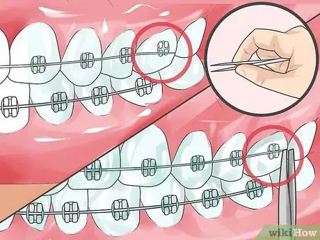 Image intitulée Handle Poking Wires on Braces Step 7