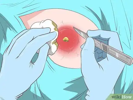 Image intitulée Recognize Staph Infection Symptoms Step 13