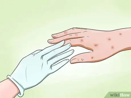 Image intitulée Avoid Getting Chicken Pox While Helping an Infected Person Step 5