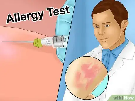 Image intitulée Recognize Hives (Urticaria) Step 11