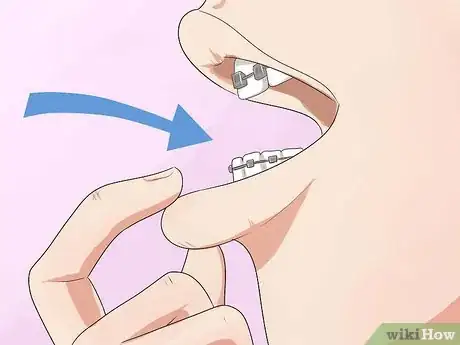 Image intitulée Make Your Braces Hurt Less Step 14