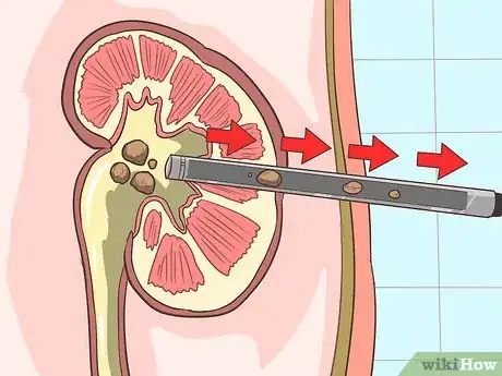 Image intitulée Treat Kidney Pain Step 12