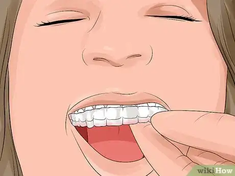 Image intitulée Prepare for Getting Braces Removed Step 9