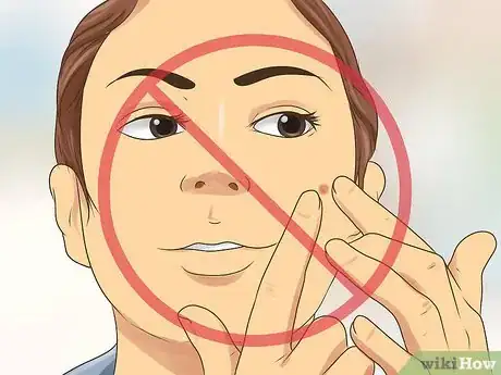 Image intitulée Erase a Pimple Scar Step 12