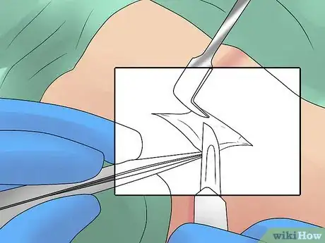 Image intitulée Treat Bursitis Step 13