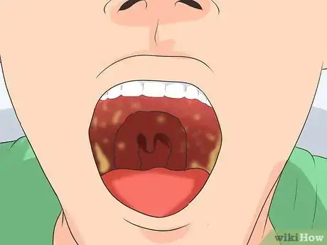 Image intitulée Recognize the Strep Throat Symptoms Step 2