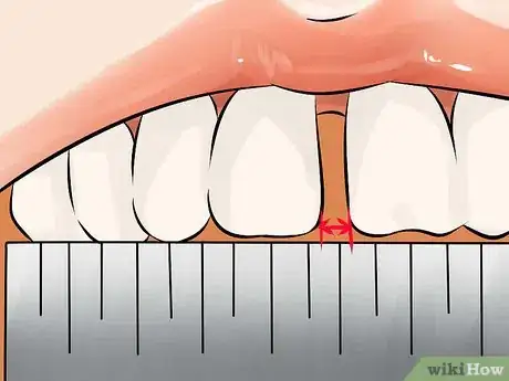 Image intitulée Get Rid of Gaps in Teeth Step 3