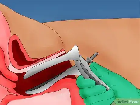 Image intitulée Do a Pap Smear Step 11