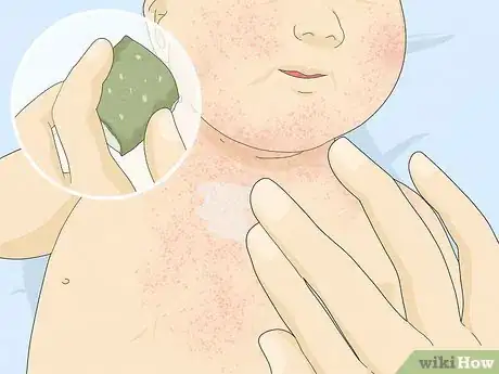 Image intitulée Treat Baby Heat Rash Step 5